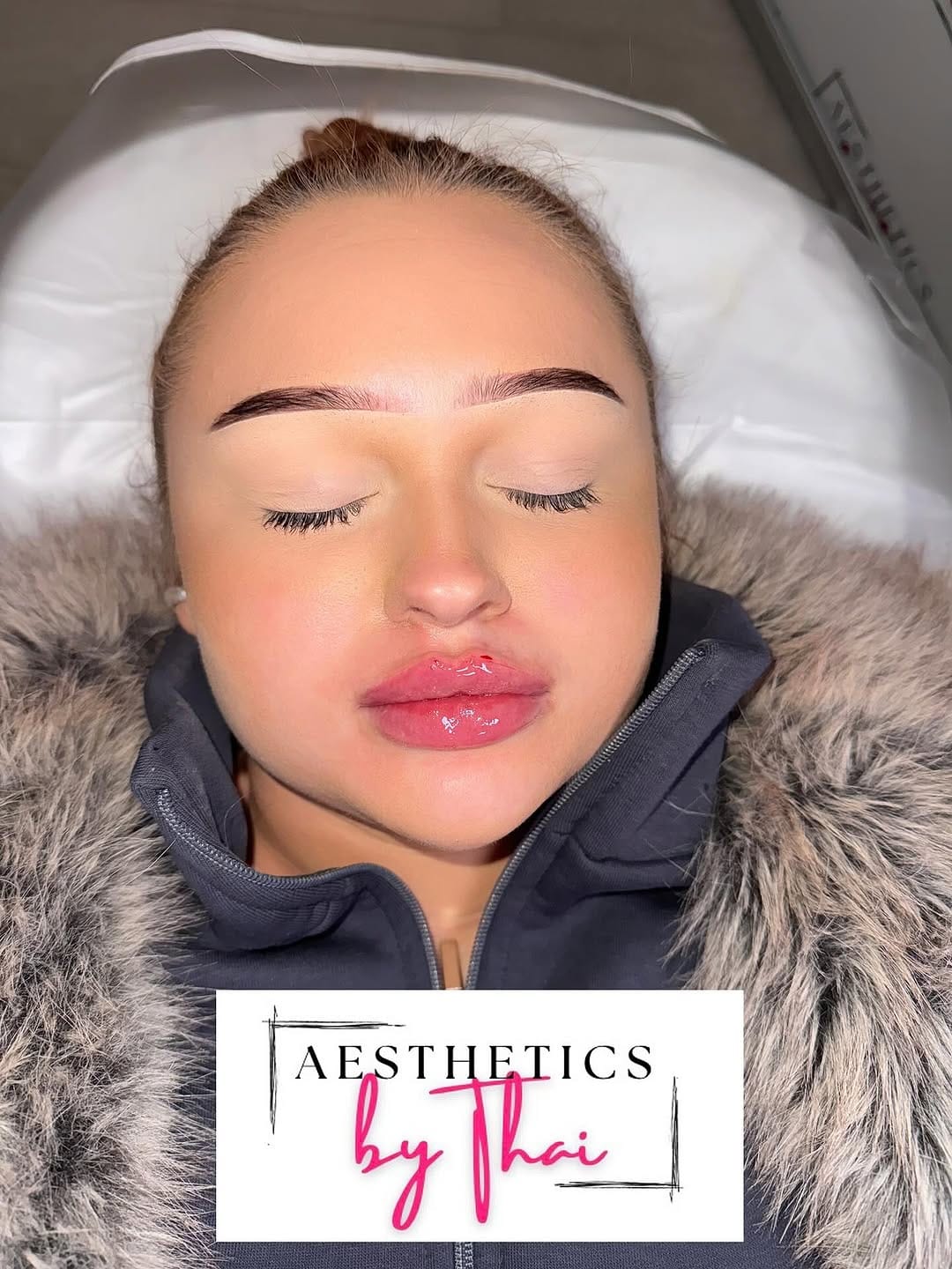 Post 4 by LIP FILLER | RUSSIAN LIPS | FILLERS | Aesthetics London on Instagram (image)