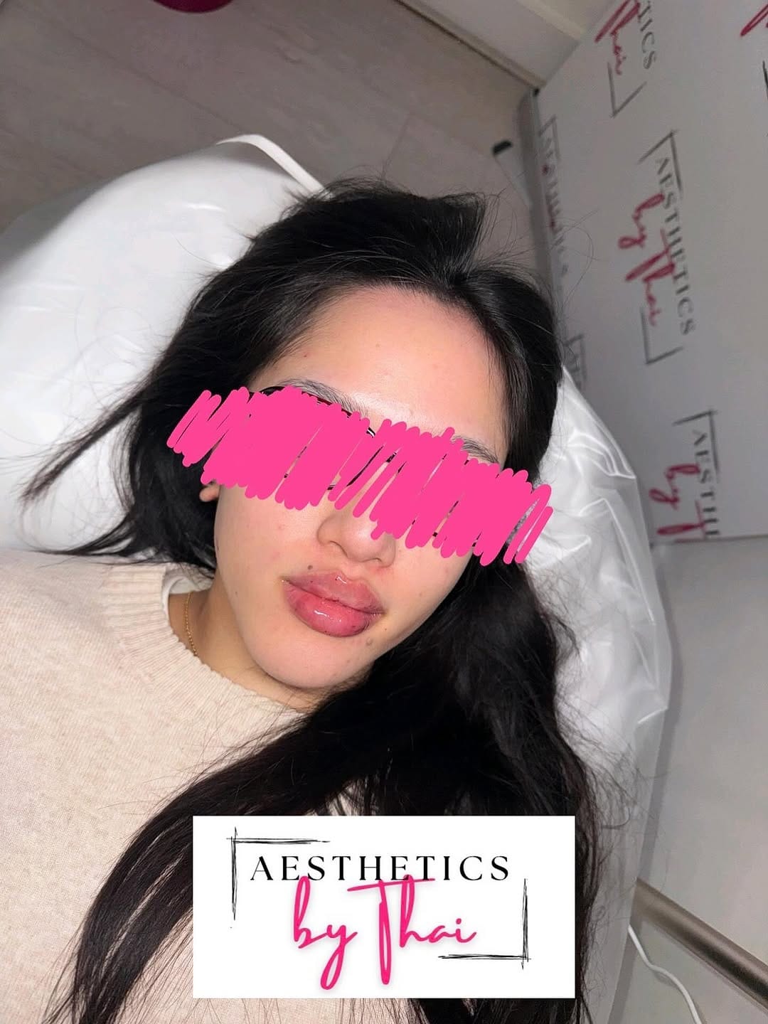 Post 7 by LIP FILLER | RUSSIAN LIPS | FILLERS | Aesthetics London on Instagram (image)