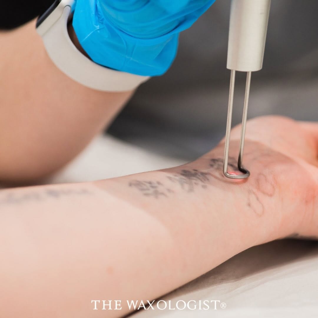 Post 4 by Hair Removal Specialist Stockport on Instagram (carousel)