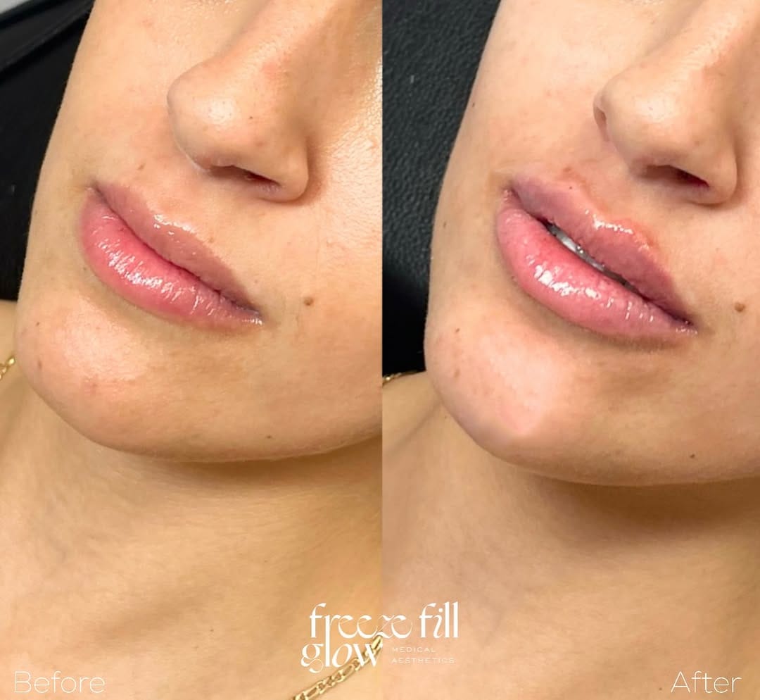 Post 1 by FreezeFillGlow || Botox•Lip Filler•Threads•PRP on Instagram (image)