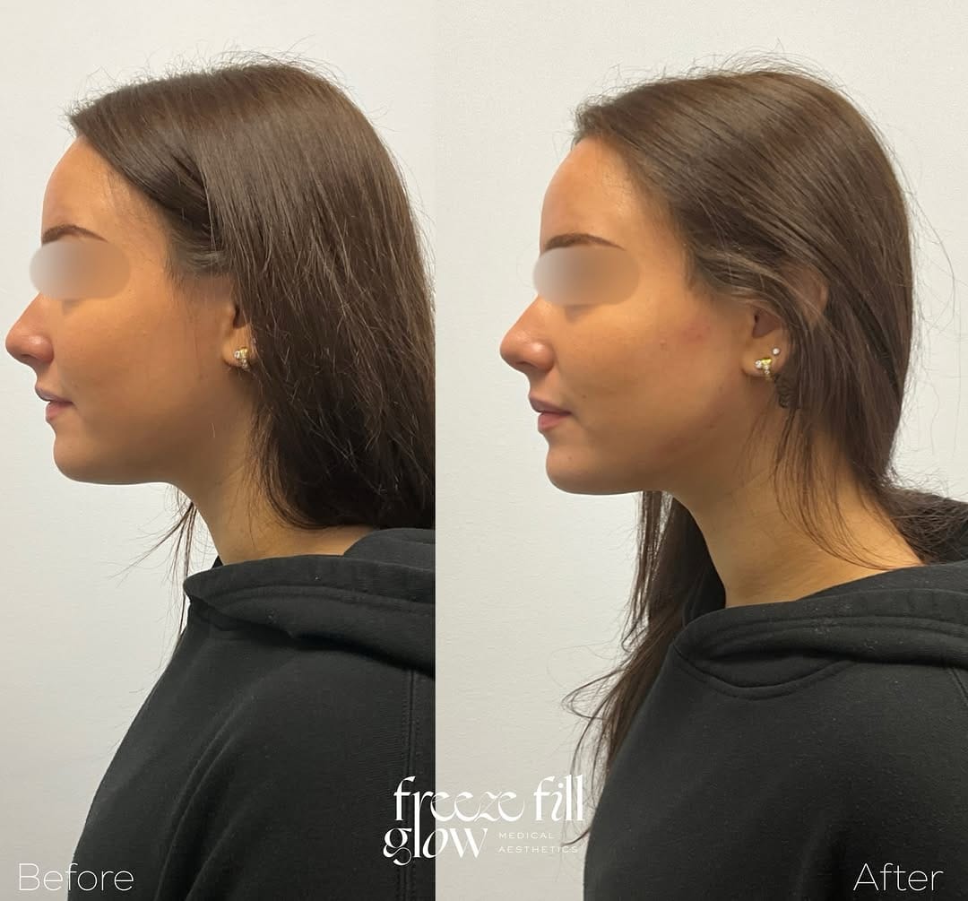 Post 10 by FreezeFillGlow || Botox•Lip Filler•Threads•PRP on Instagram (carousel)