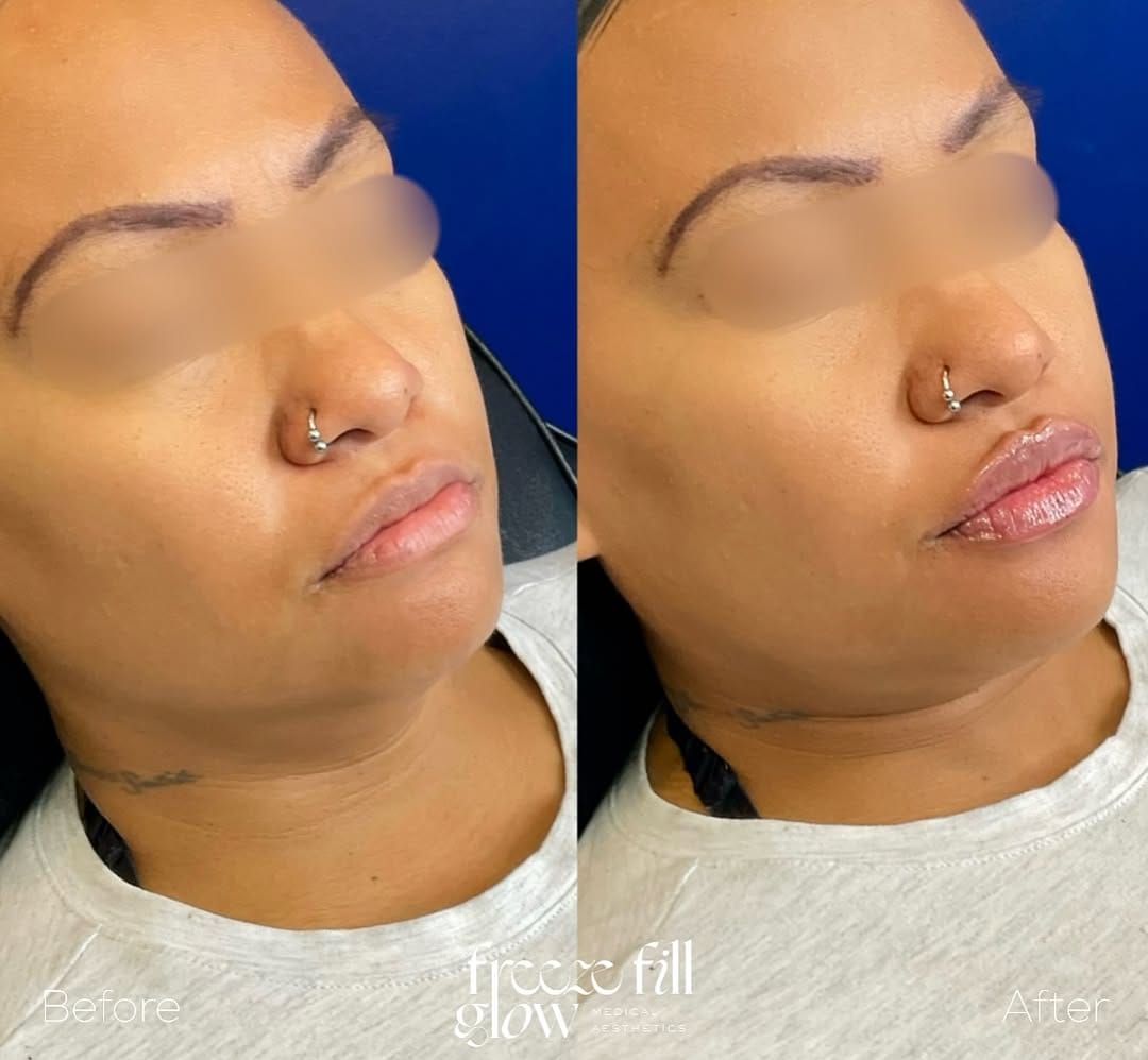 Post 7 by FreezeFillGlow || Botox•Lip Filler•Threads•PRP on Instagram (image)