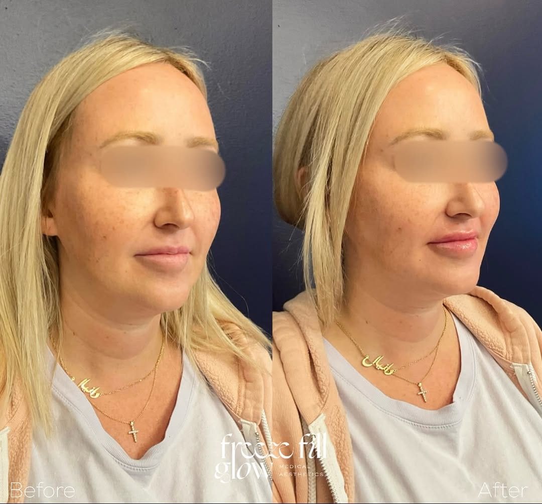 Post 4 by FreezeFillGlow || Botox•Lip Filler•Threads•PRP on Instagram (carousel)