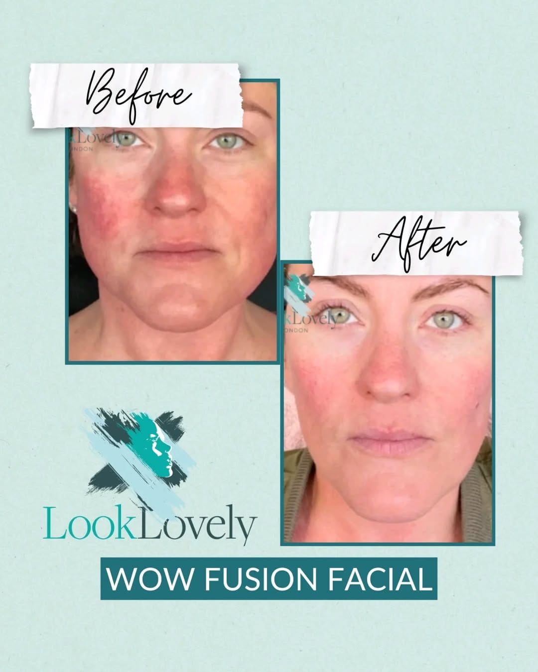 Post 9 by Look Lovely London | Medical Aesthetics on Instagram (image)