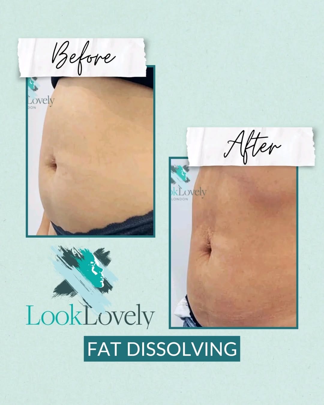 Post 6 by Look Lovely London | Medical Aesthetics on Instagram (image)