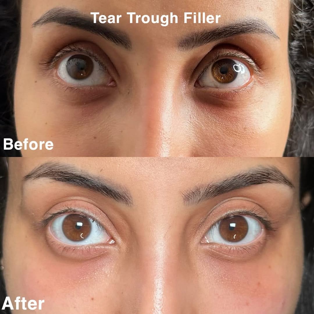 Post 1 by Lip Filler • Lash Tech • Lip Neutralisation • Hackney 🇬🇧 on Instagram (image)