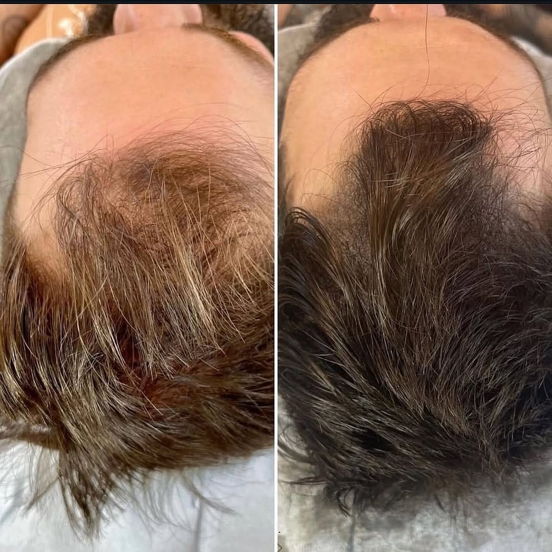 Post 8 by Keratin/Botox/Nanoplastia/Hair Loss/ on Instagram (image)