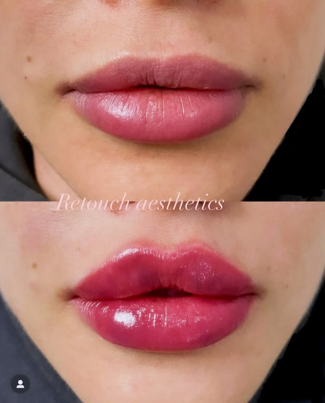 Post 5 by Retouch Aesthetics on Instagram (image)