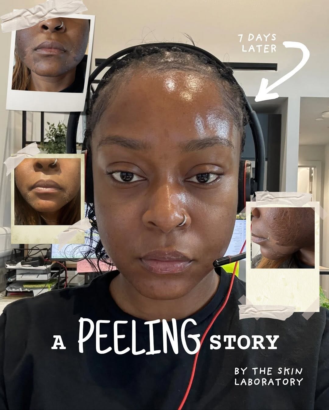 Post 10 by FACIALS, HYDRAFACIAL, DERMAPLANE, MICRONEEDLING, HERBAL PEELS on Instagram (carousel)