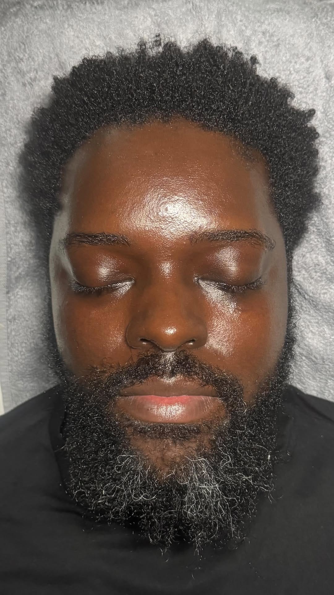 Post 8 by FACIALS, HYDRAFACIAL, DERMAPLANE, MICRONEEDLING, HERBAL PEELS on Instagram (video)
