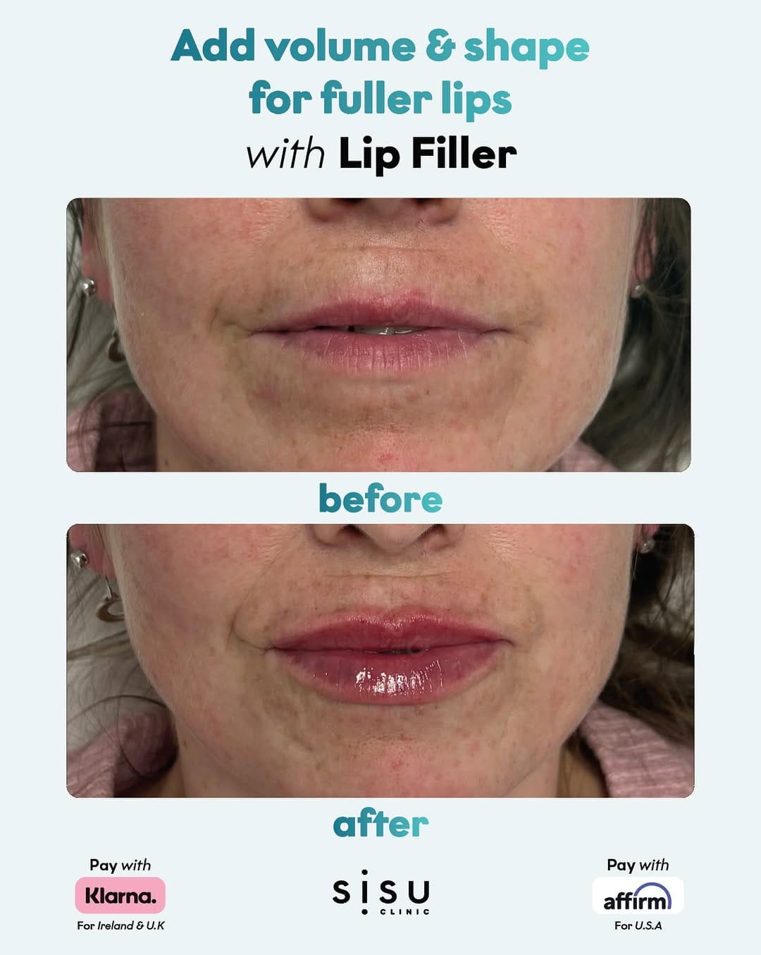 Post 7 by Sisu Clinic - U.K | Filler. Profhilo. Polynucleotides. on Instagram (image)
