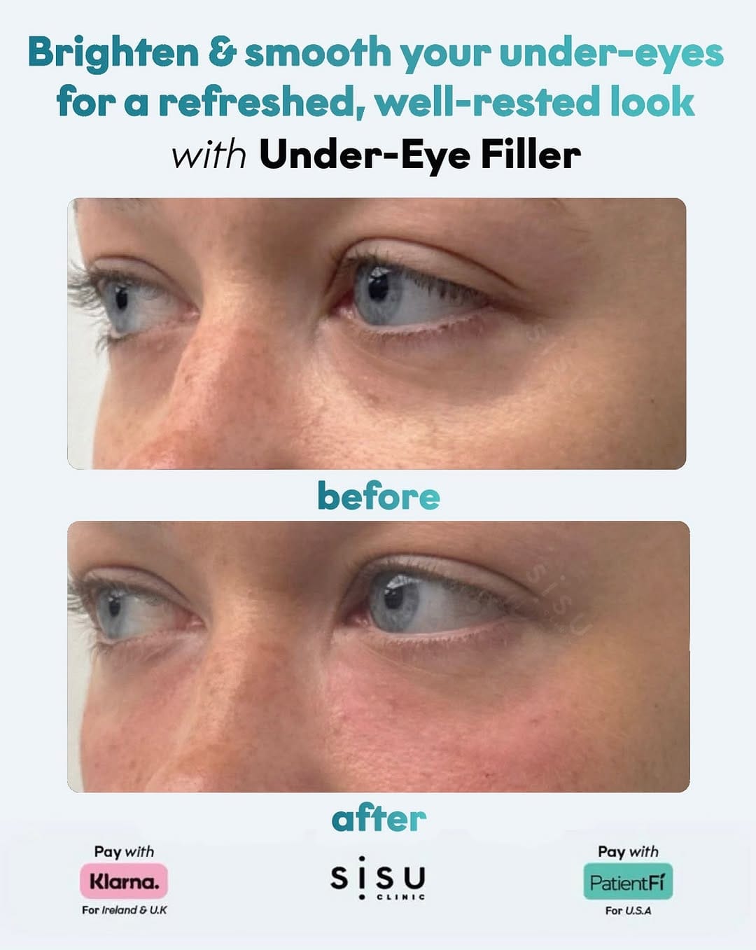 Post 3 by Sisu Clinic - U.K | Filler. Profhilo. Polynucleotides. on Instagram (carousel)