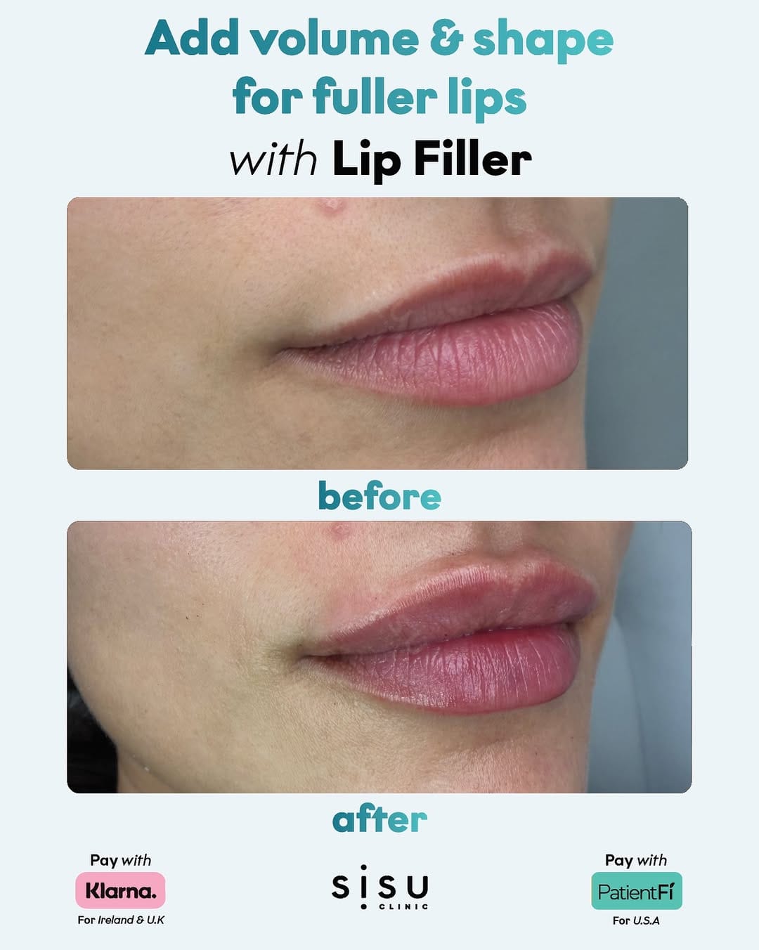 Post 1 by Sisu Clinic - U.K | Filler. Profhilo. Polynucleotides. on Instagram (image)