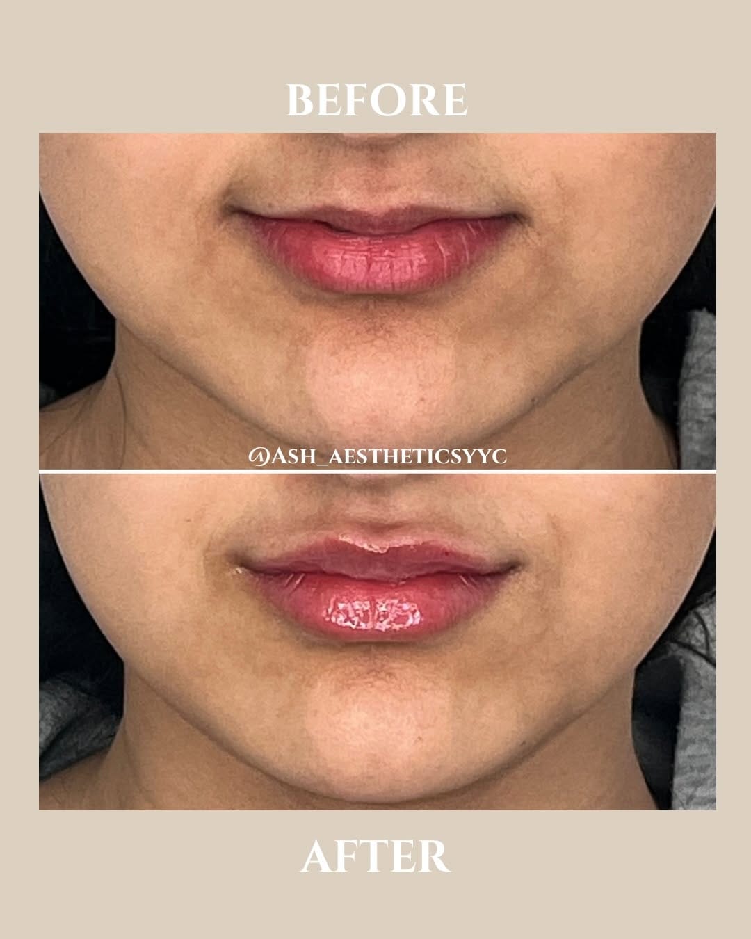 Post 4 by ENVY YYC | BOTOX + FILLER + SKIN + LASER on Instagram (carousel)