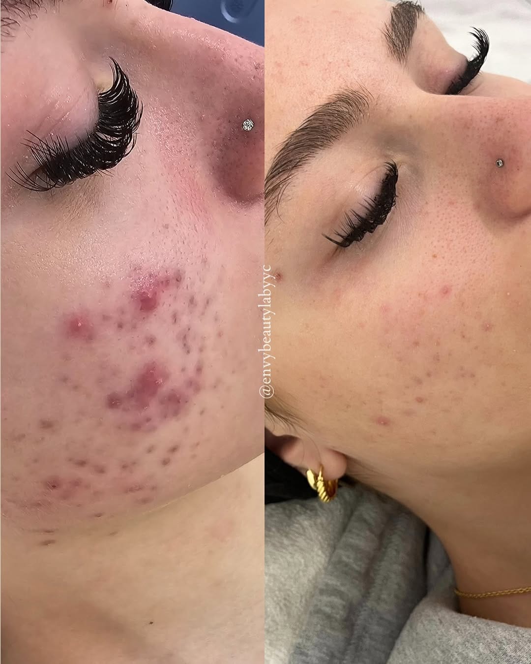 Post 6 by ENVY YYC | BOTOX + FILLER + SKIN + LASER on Instagram (image)