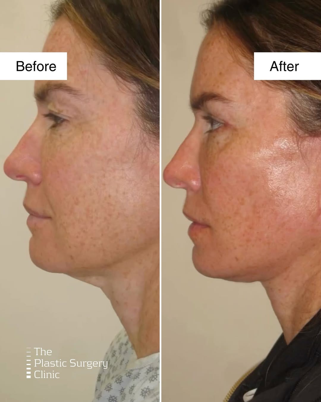Post 9 by The Plastic Surgery Clinic on Instagram (carousel)