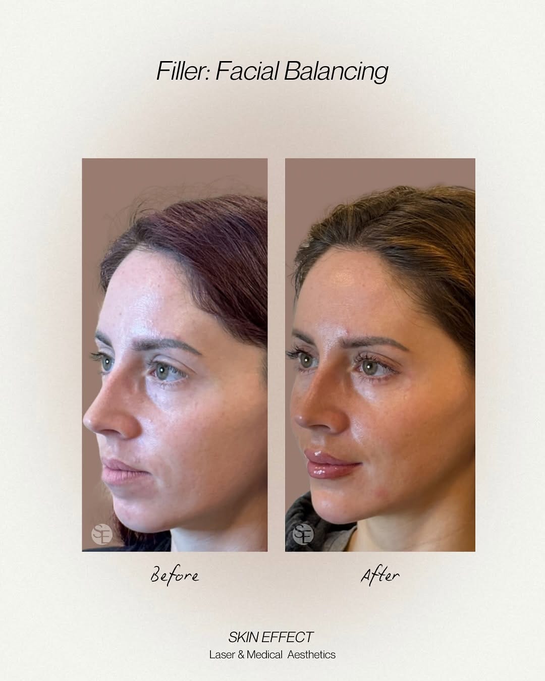 Post 10 by Skin Effect | YEG Medical Aesthetics Spa on Instagram (carousel)