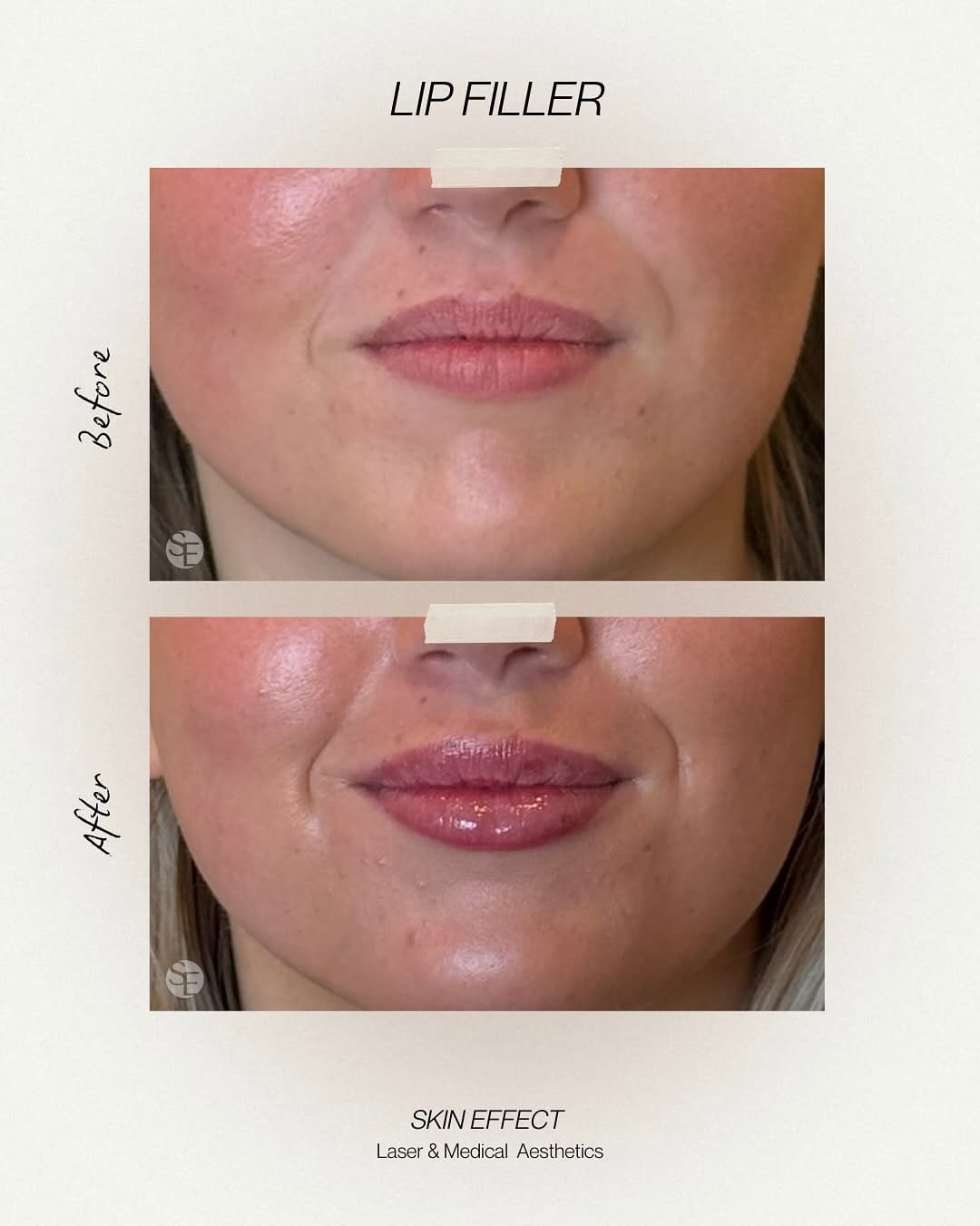 Post 2 by Skin Effect | YEG Medical Aesthetics Spa on Instagram (carousel)