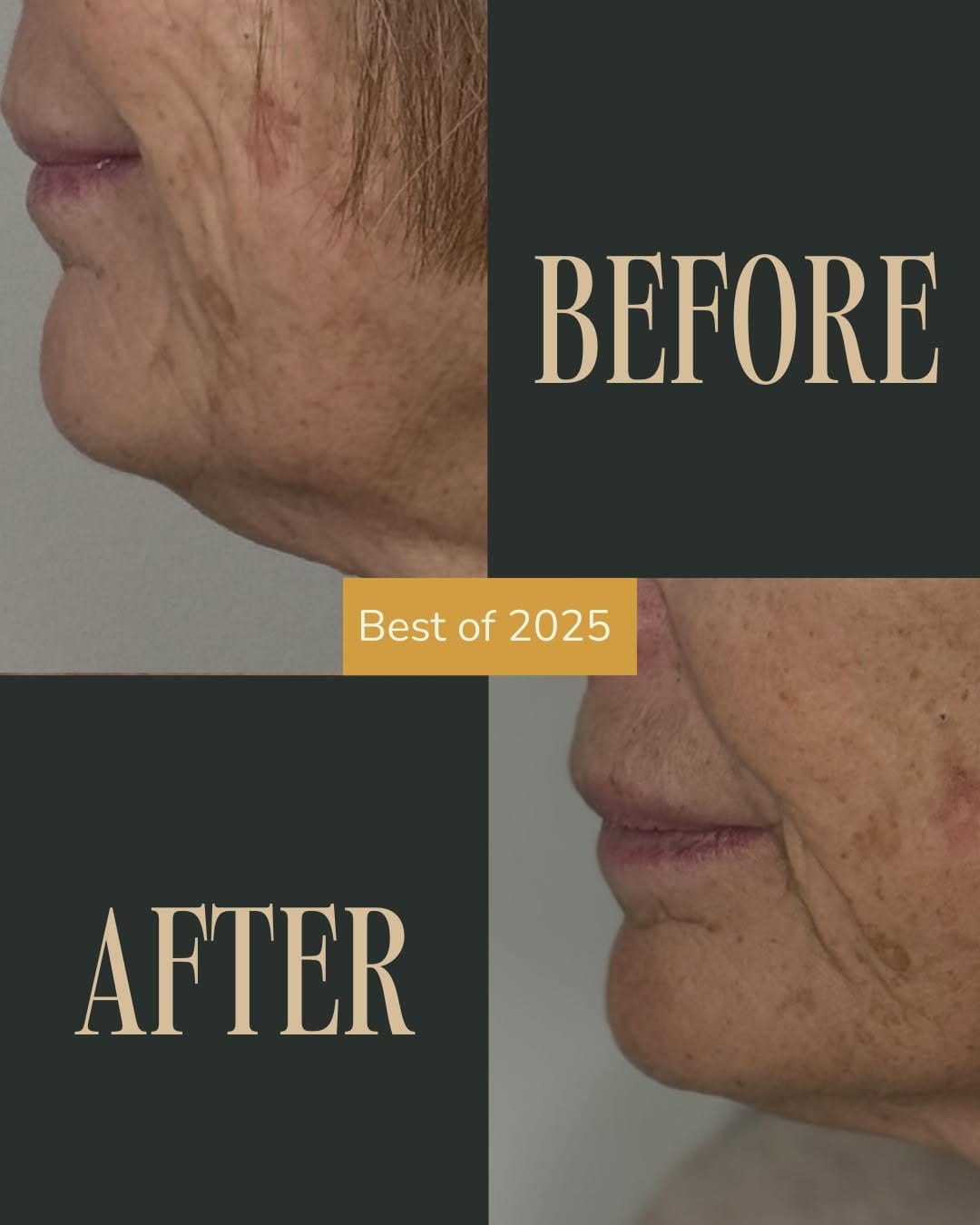 Post 5 by NINA Aesthetics - CALGARY ADVANCED MEDICAL AESTHETICS on Instagram (carousel)