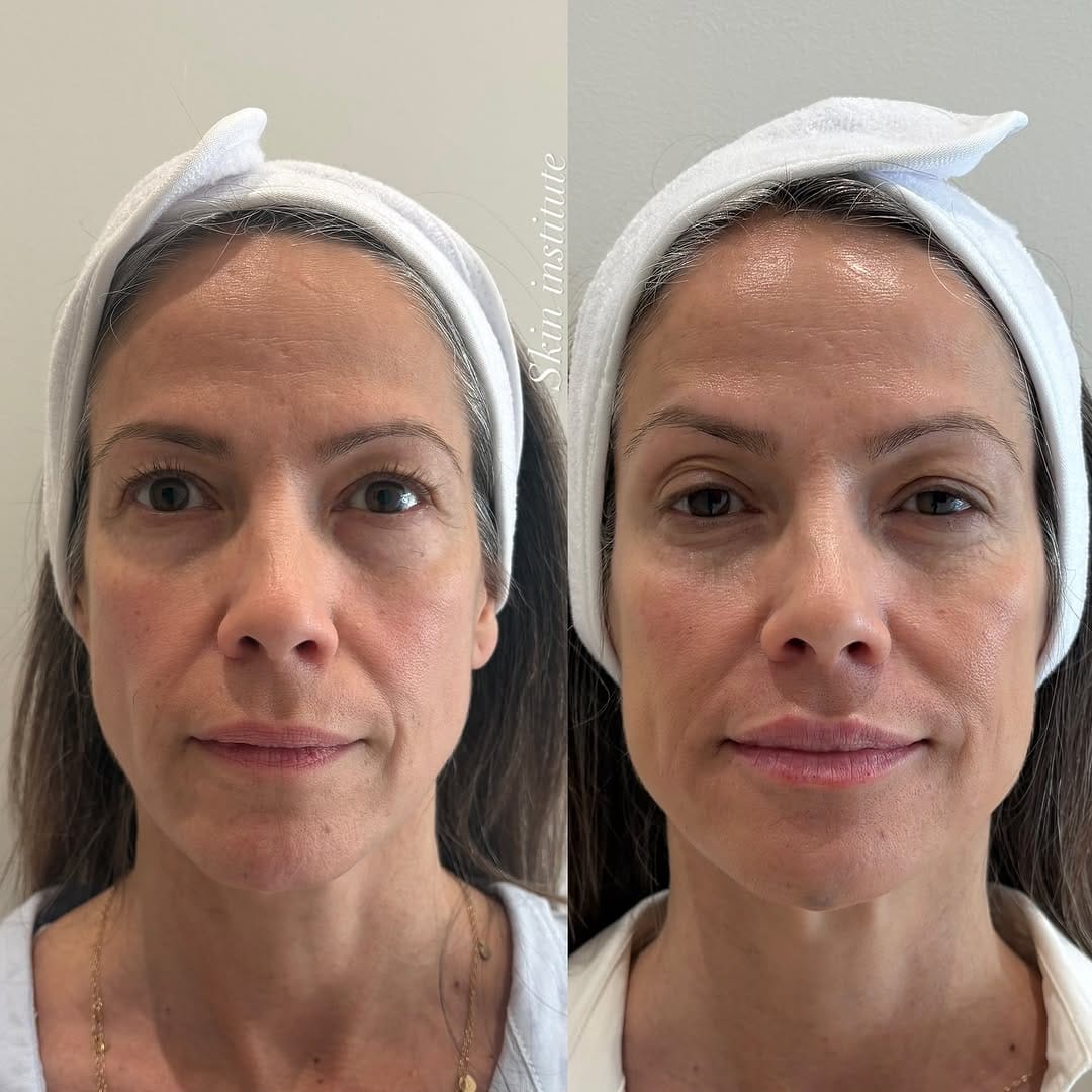 Post 4 by SKIN INSTITUTE | FILLER • FACIALS • WELLNESS on Instagram (carousel)