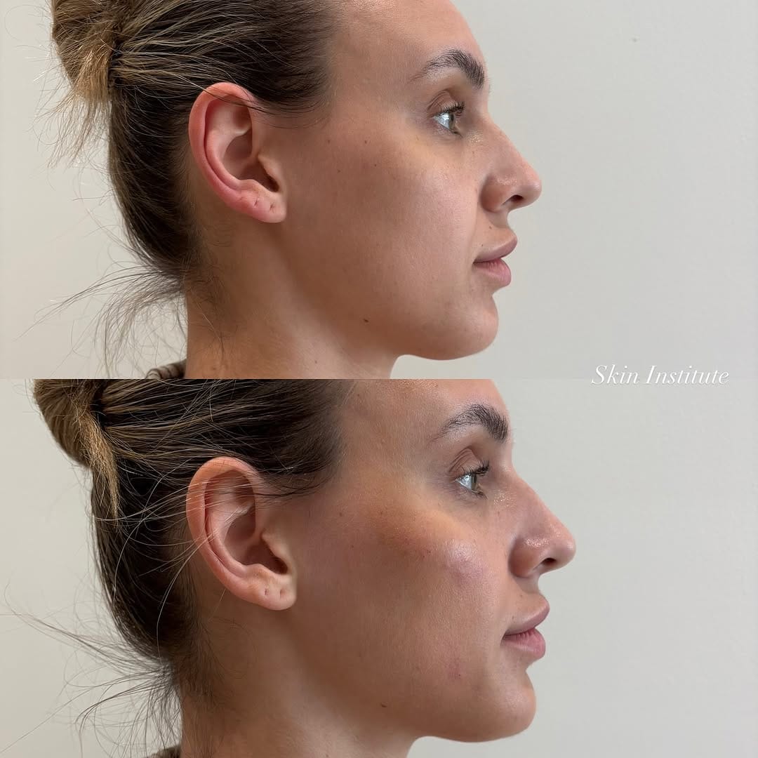 Post 5 by SKIN INSTITUTE | FILLER • FACIALS • WELLNESS on Instagram (carousel)