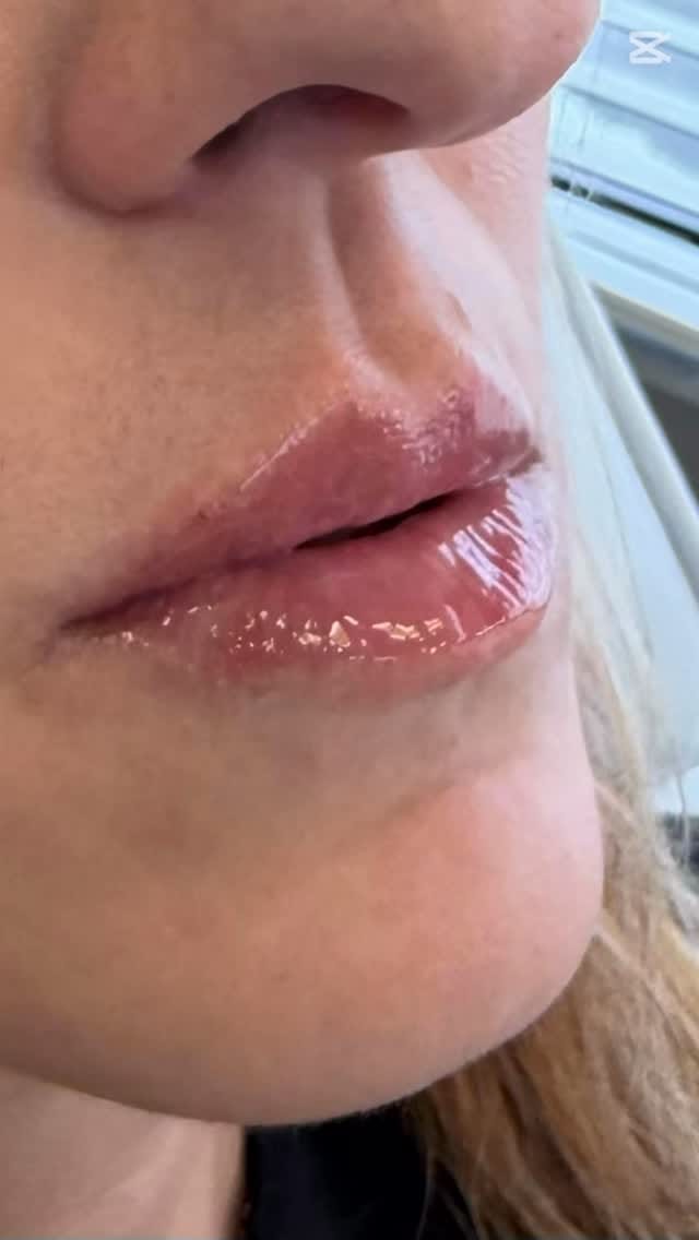 Post 1 by Botox.Lip Filler.Alastin.Dysport.PRP.PRF on Instagram (video)