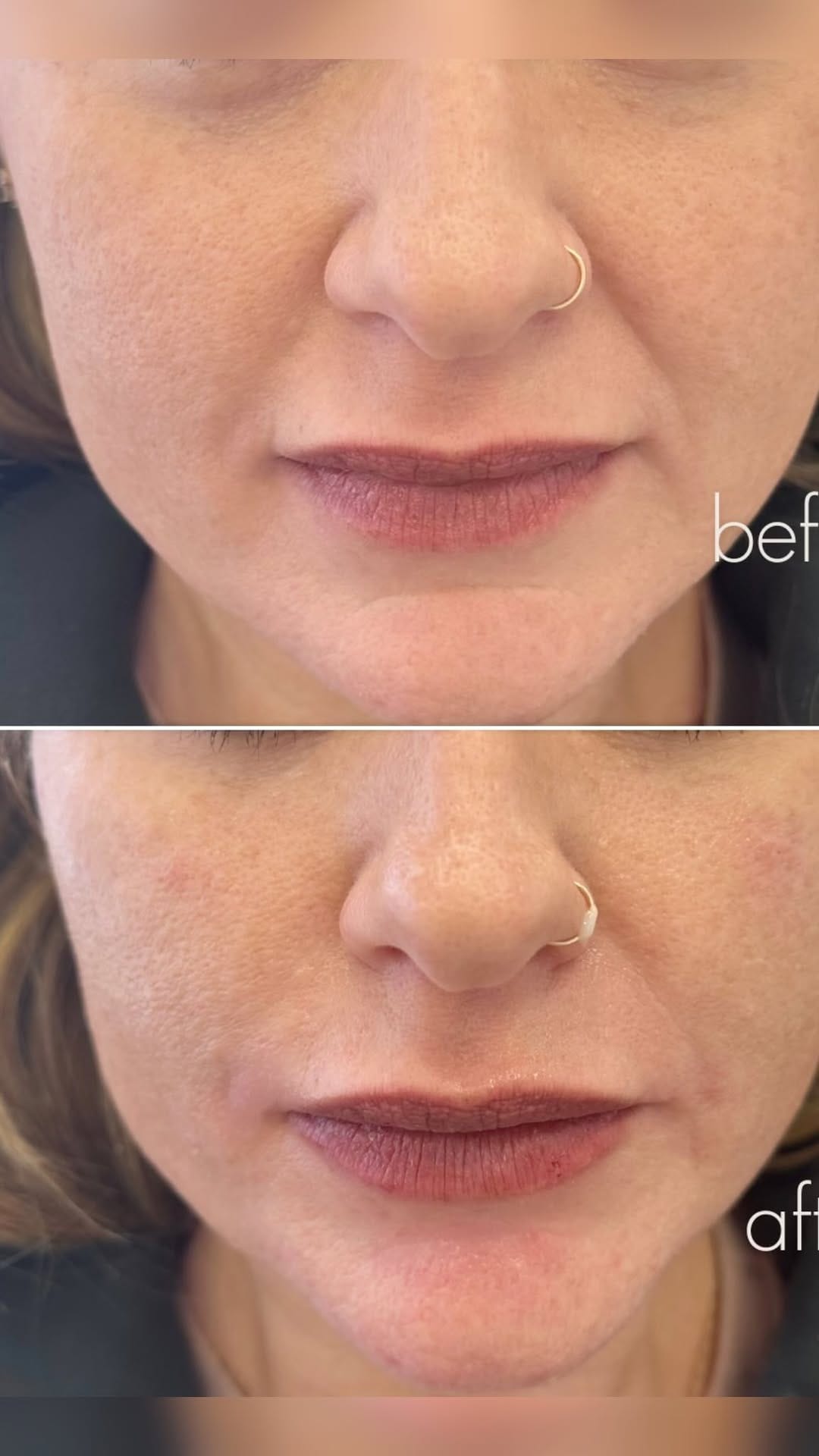 Post 6 by Botox.Lip Filler.Alastin.Dysport.PRP.PRF on Instagram (video)