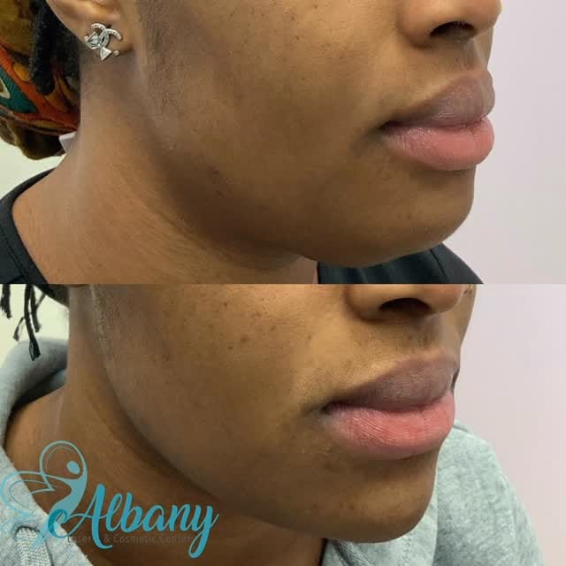 Post 8 by AlbanyCosmeticLaserCentre on Instagram (video)