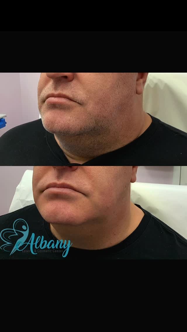 Post 5 by AlbanyCosmeticLaserCentre on Instagram (video)