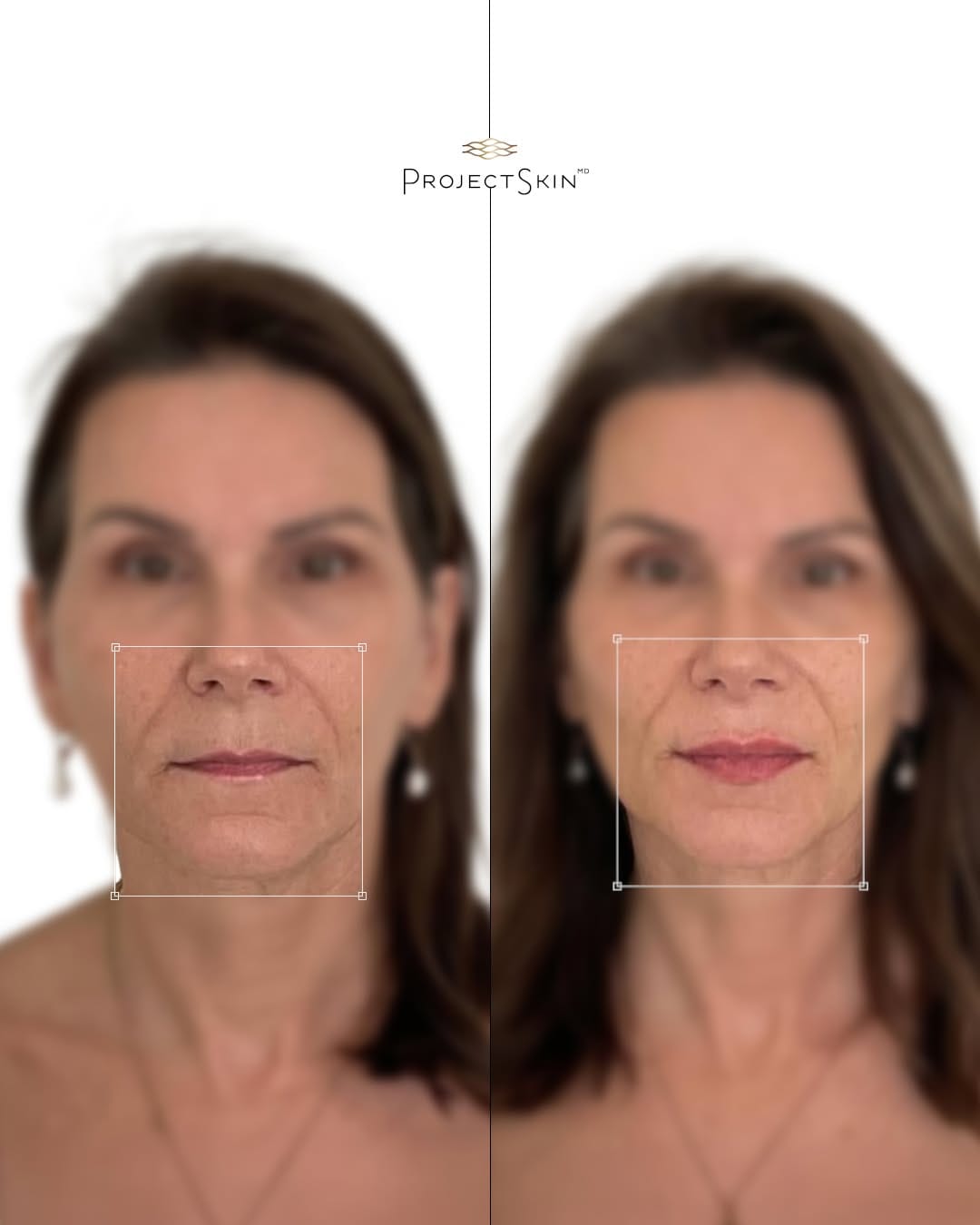 Post 7 by Project Skin MD Vancouver on Instagram (carousel)