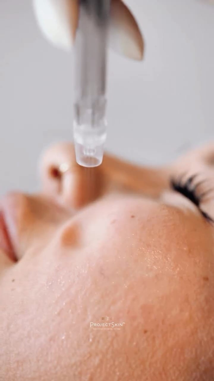 Post 10 by Project Skin MD Vancouver on Instagram (video)