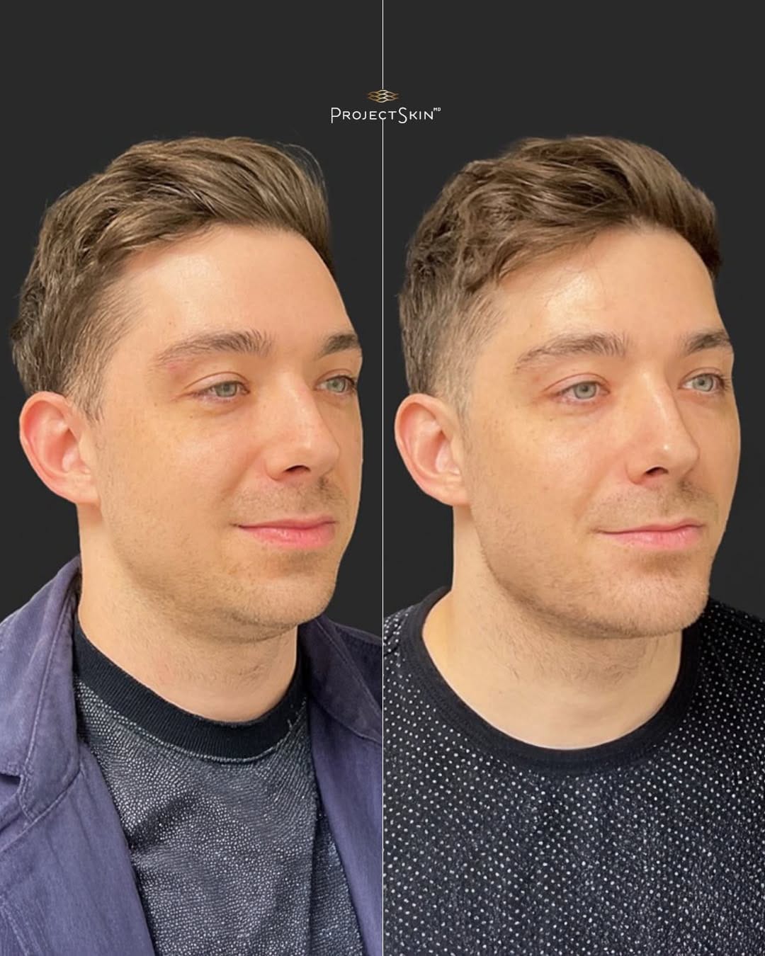 Post 9 by Project Skin MD Vancouver on Instagram (image)