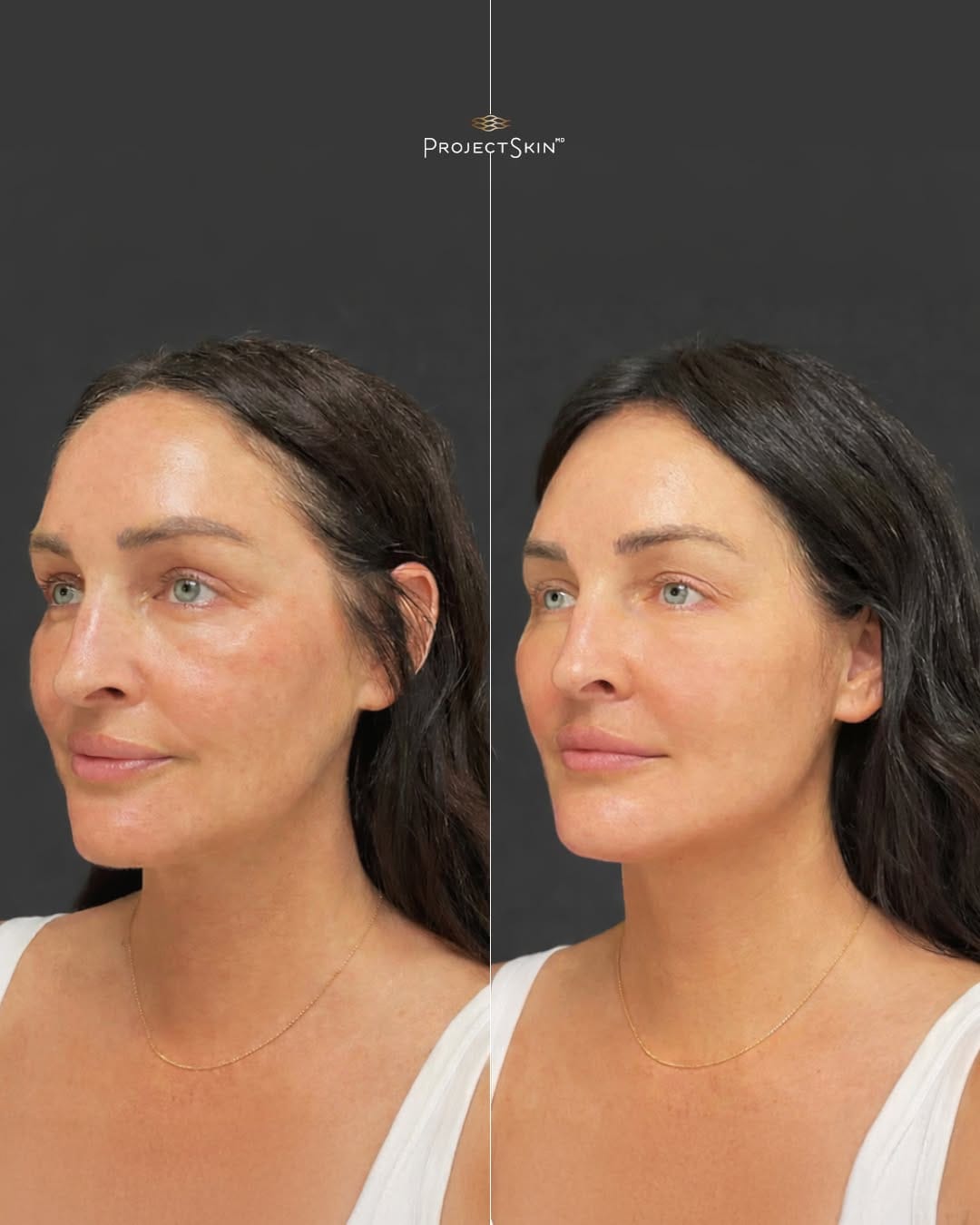 Post 5 by Project Skin MD Vancouver on Instagram (image)