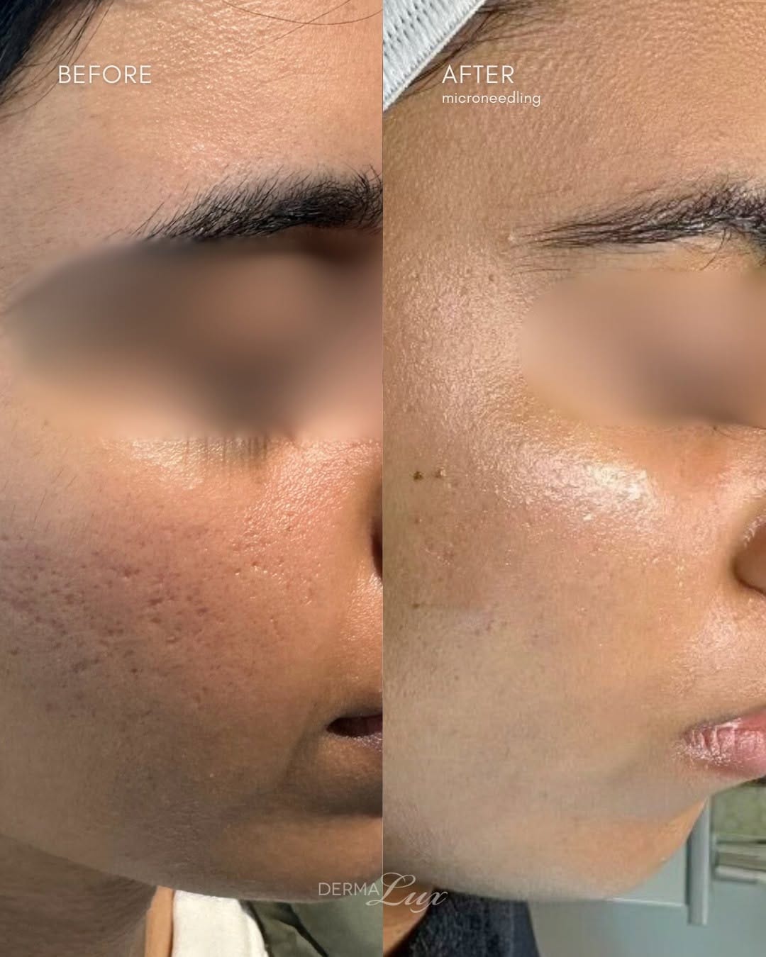 Post 5 by DermaLux Medical Aesthetics Spa on Instagram (carousel)