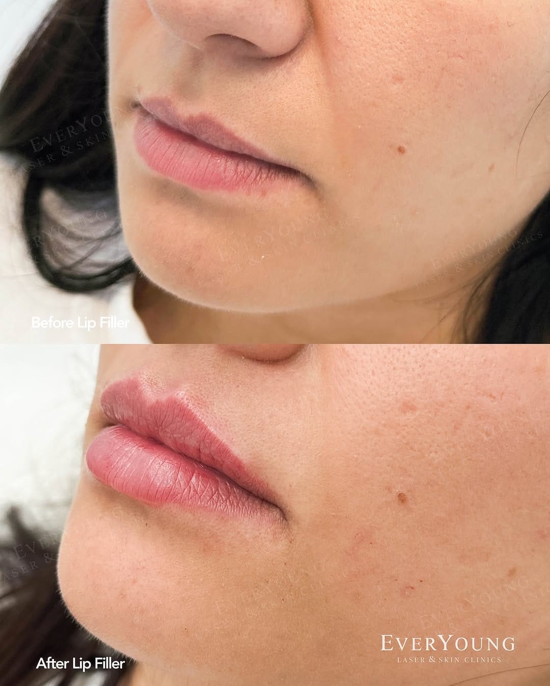 Post 8 by EverYoung Laser & Skin Clinics | Vancouver on Instagram (image)