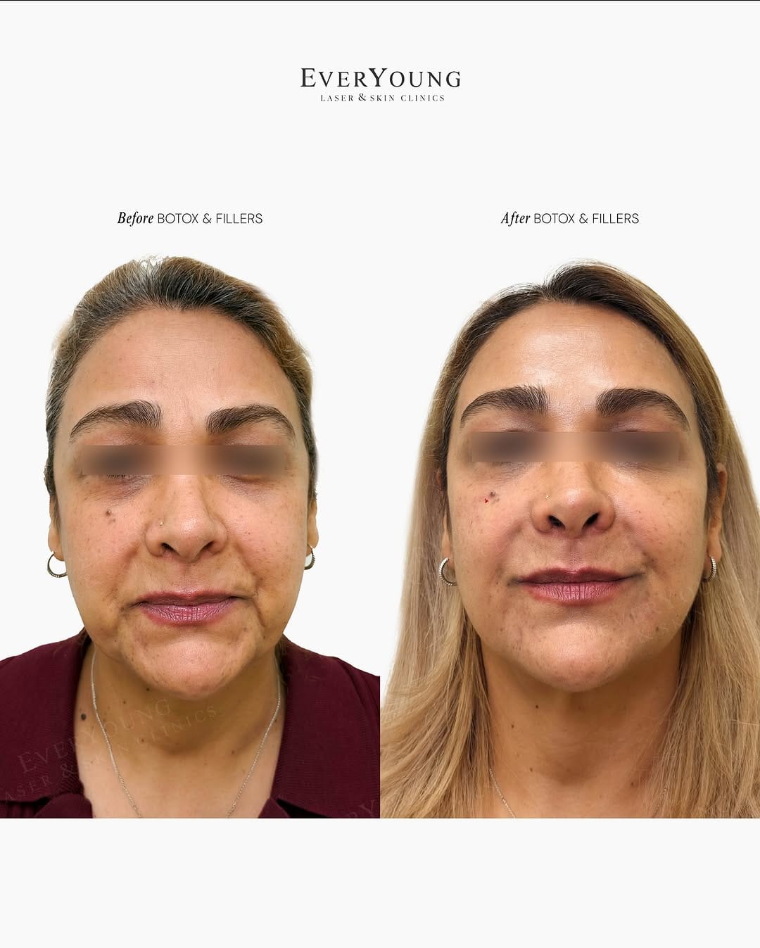 Post 1 by EverYoung Laser & Skin Clinics | Vancouver on Instagram (image)