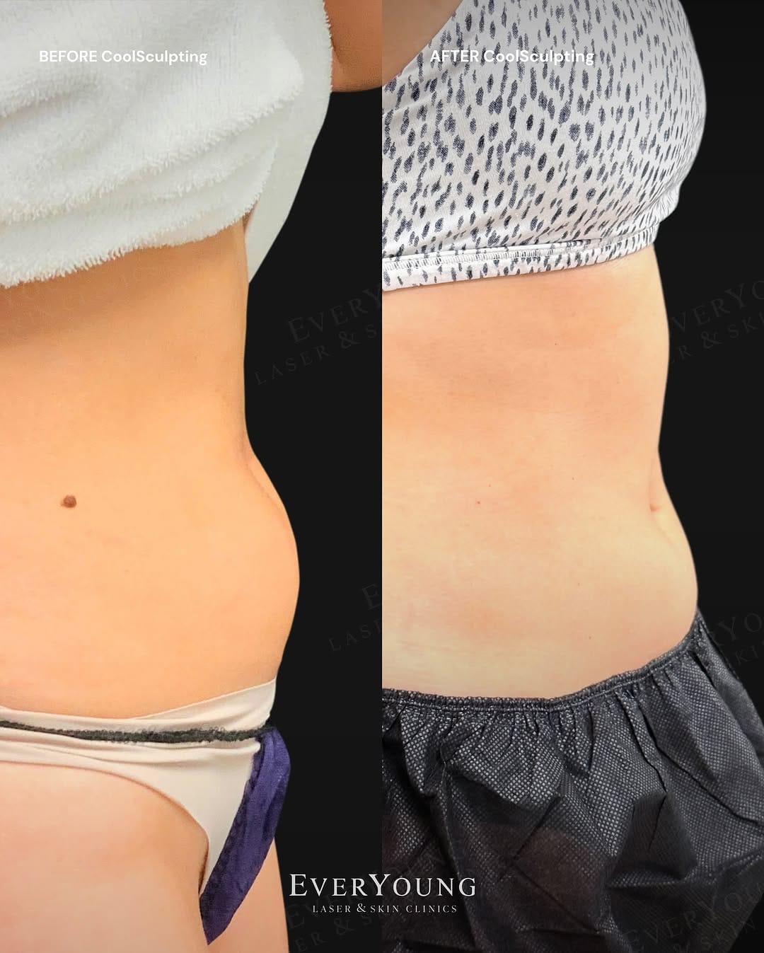 Post 5 by EverYoung Laser & Skin Clinics | Vancouver on Instagram (image)