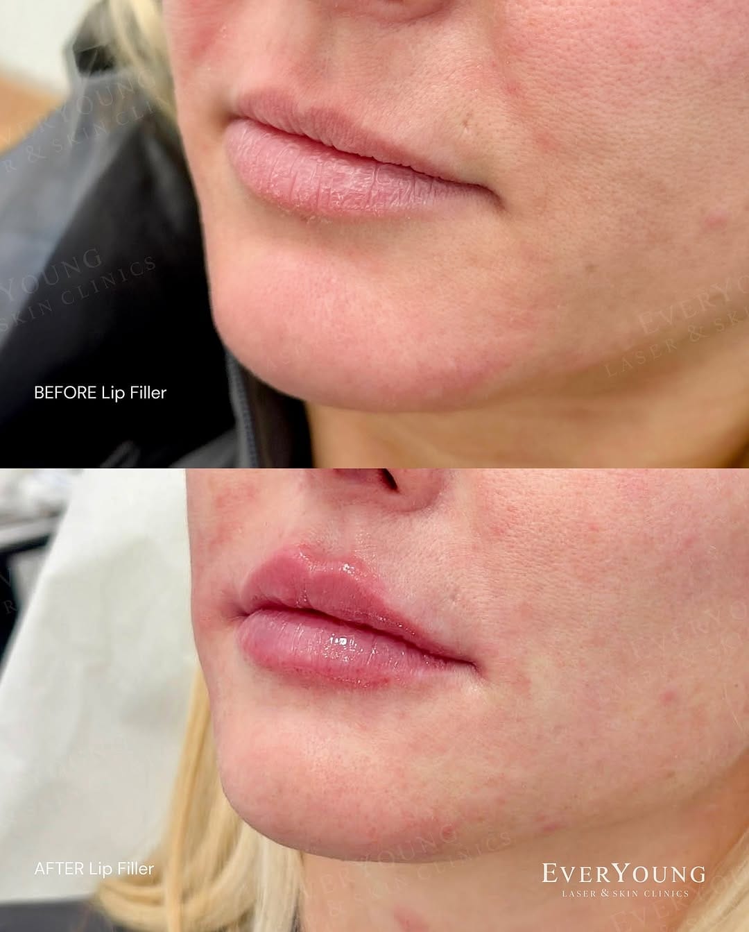 Post 4 by EverYoung Laser & Skin Clinics | Vancouver on Instagram (image)