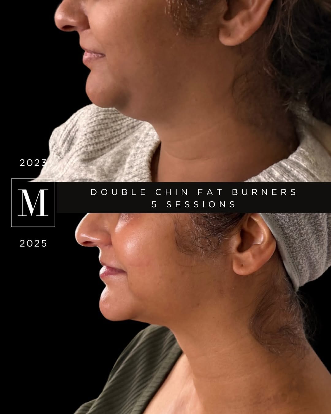 Post 6 by Monaco Medical Aesthetics on Instagram (carousel)