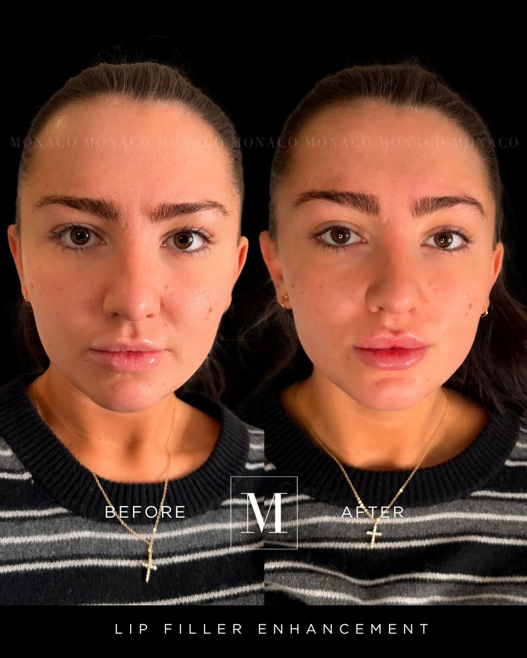 Post 8 by Monaco Medical Aesthetics on Instagram (carousel)