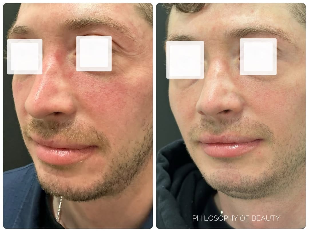 Post 4 by Fillers | Emface | CoolSculpting | HydraFacial | Lasers on Instagram (carousel)
