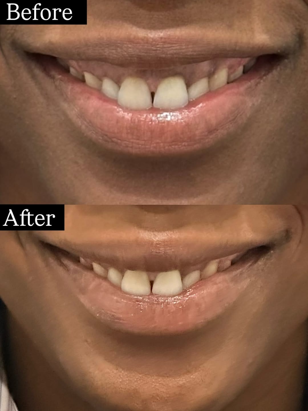 Post 9 by Fillers | Emface | CoolSculpting | HydraFacial | Lasers on Instagram (carousel)