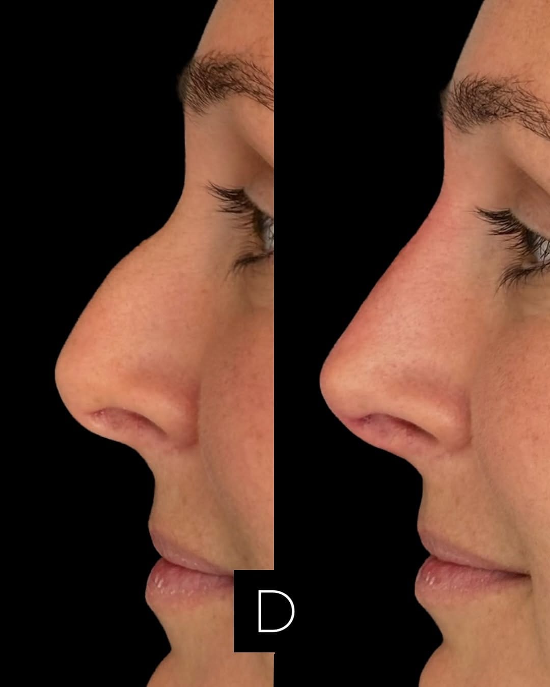 Post 9 by Asmaa Kabouya | Botox, Fillers on Instagram (carousel)