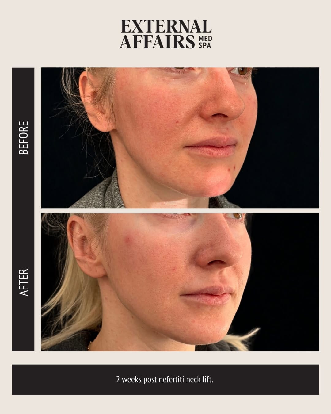 Post 6 by EA Med Spa | 30+ Years of Injection + Skin Expertise on Instagram (carousel)