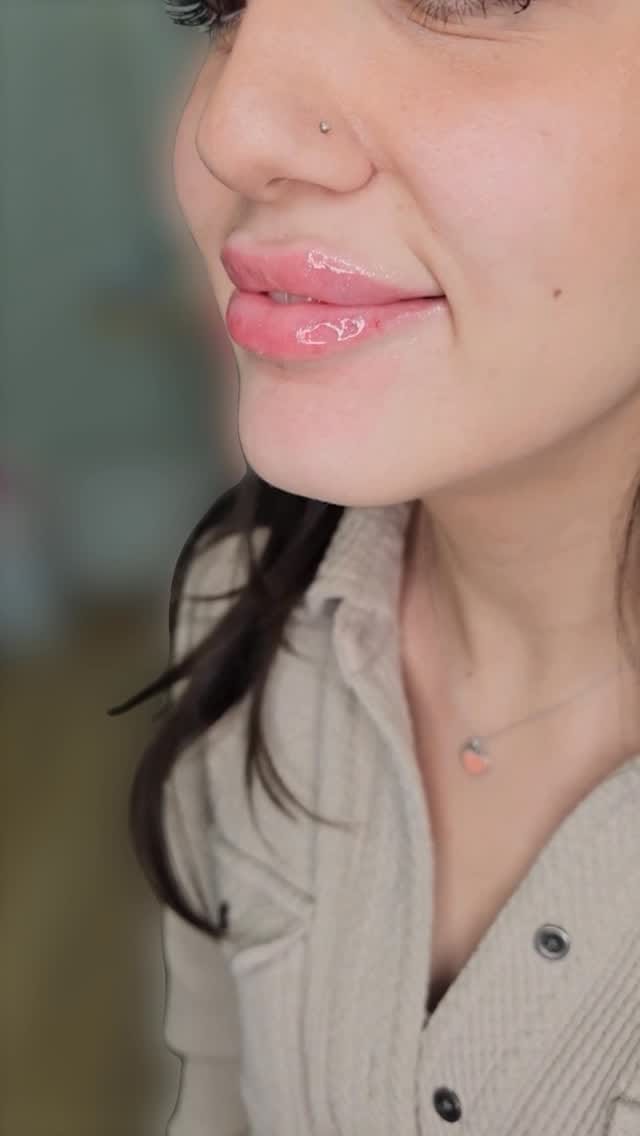 Post 7 by Farah Chahine | 📍Botox & Fillers Injector Vaughan & Ajax on Instagram (video)