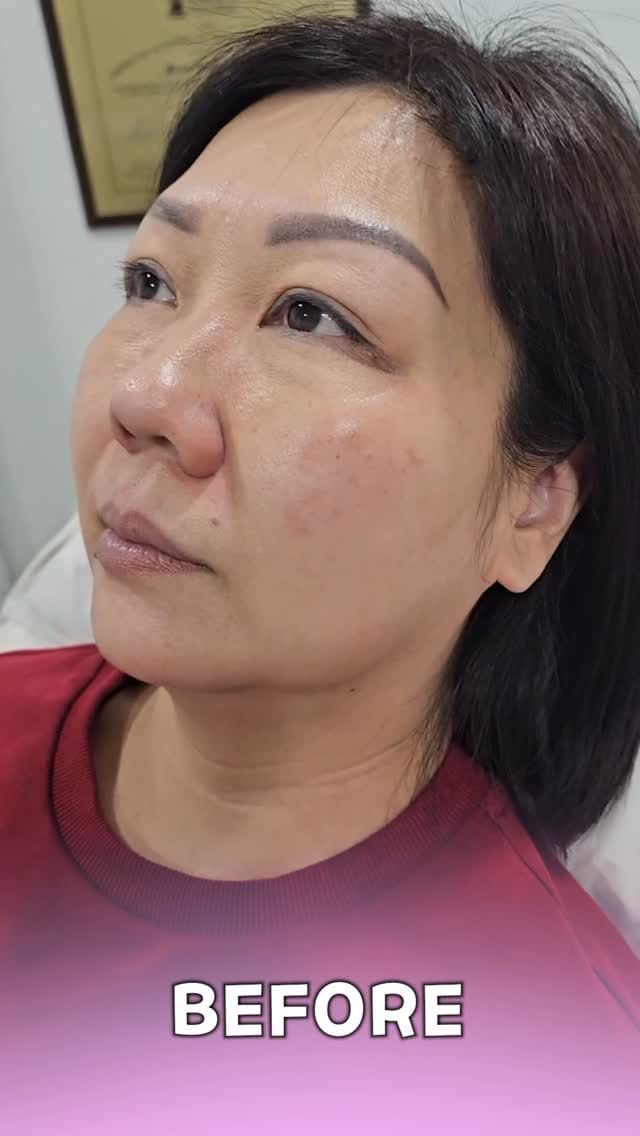 Post 5 by Farah Chahine | 📍Botox & Fillers Injector Vaughan & Ajax on Instagram (video)