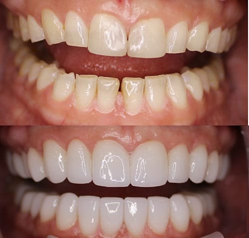 Post 3 by Veneers Toronto ™️ on Instagram (image)