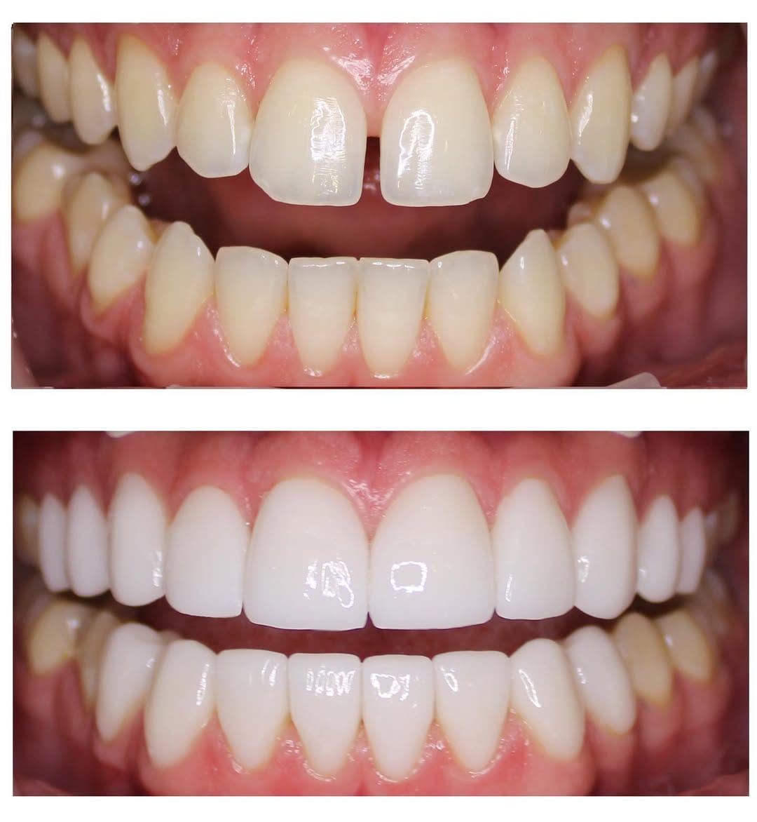 Post 10 by Veneers Toronto ™️ on Instagram (carousel)