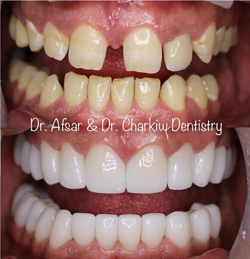 Post 7 by Veneers Toronto ™️ on Instagram (image)