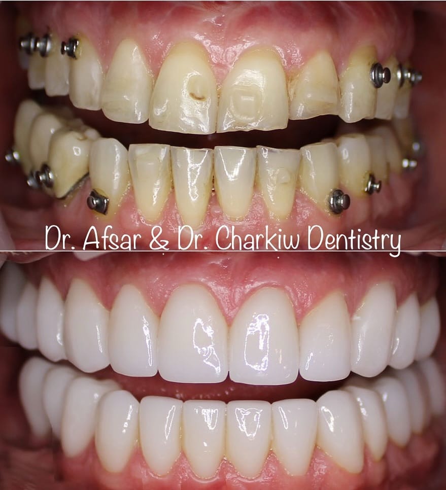 Post 5 by Veneers Toronto ™️ on Instagram (image)